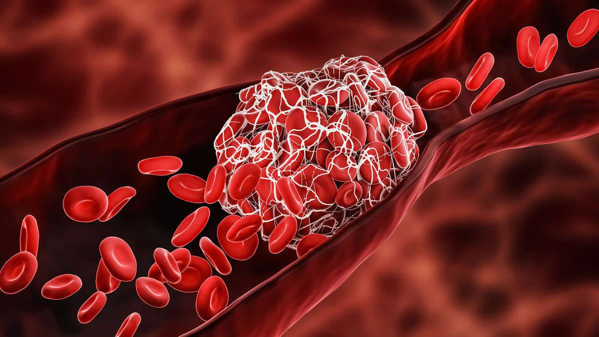 Enzymes for thrombus treatment by Creative Enzymes.